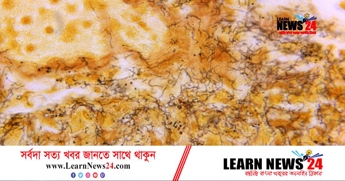 যুক্তরাষ্ট্রে ‘নিয়ন্ত্রণের বাইরে’ যৌনরোগ