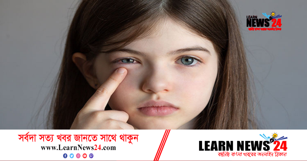 চোখ উঠলে অবশ্যই যা করবেন