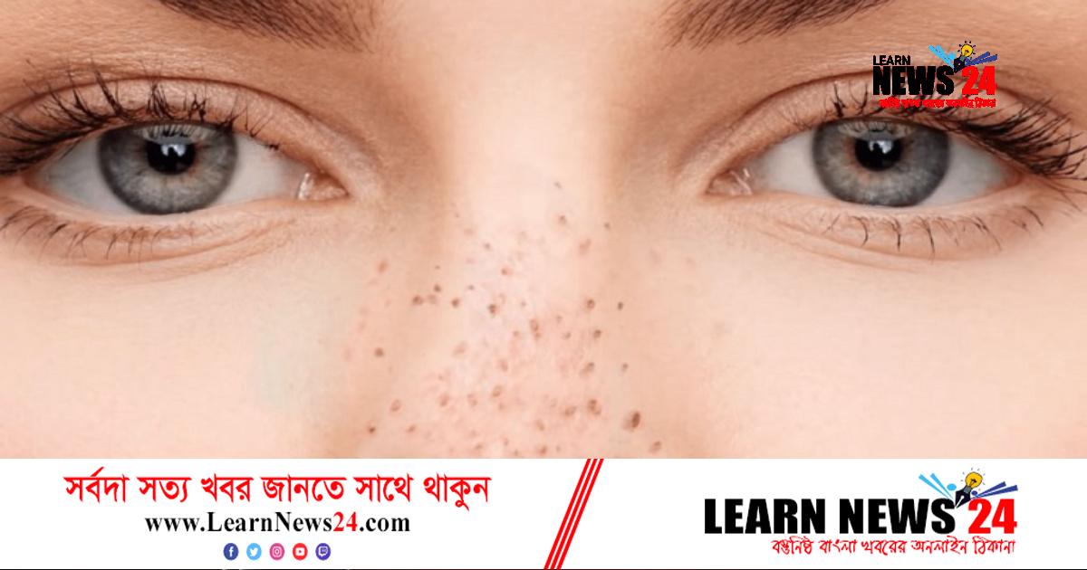 নাকের ব্ল্যাকহেডস নিমিষেই দূর করবেন যেভাবে নাকের ব্ল্যাকহেডস নিমিষেই দূর করবেন যেভাবে