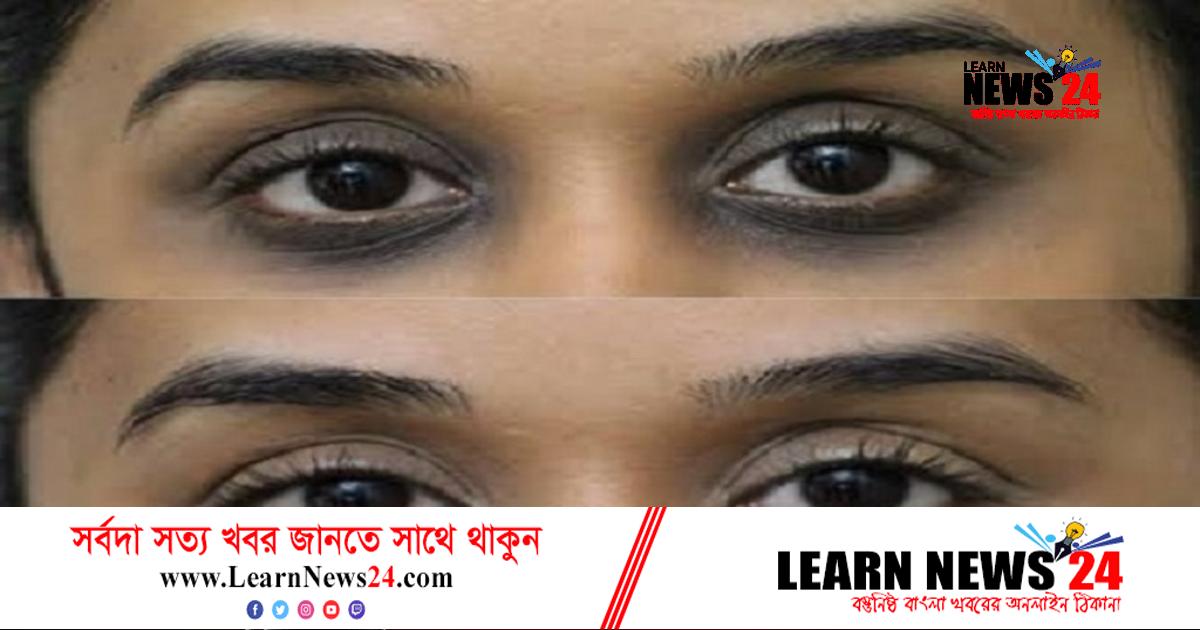 ডার্ক সার্কেলের জন্য ঘরোয়া উপায়