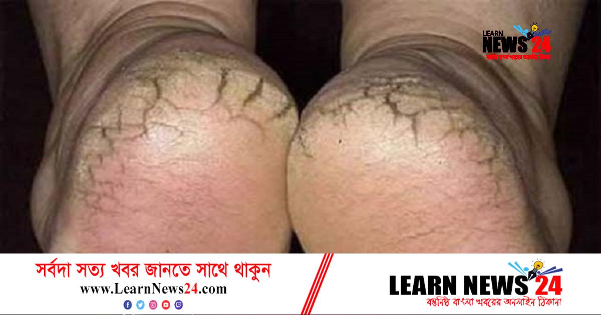 গোড়ালি ফাটা রোধে ভিনেগার মিশ্রিত পানি গোড়ালি ফাটা রোধে ভিনেগার মিশ্রিত পানি