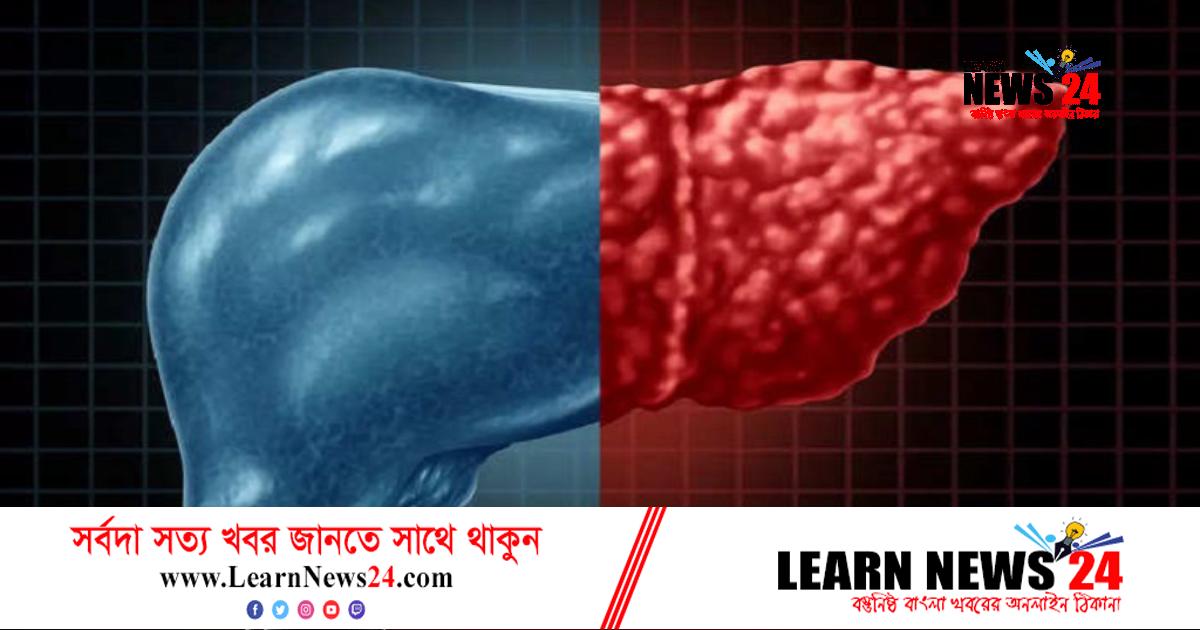 লিভার ড্যামেজের লক্ষণ ও প্রতিকার জেনে নিন