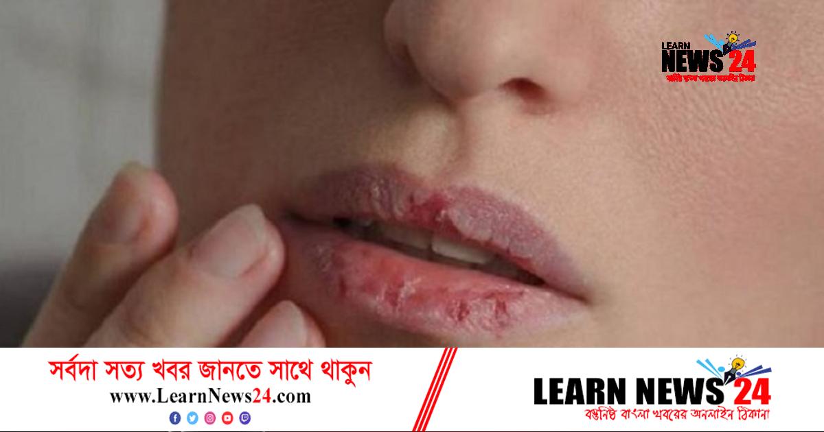 কেন শীতে ঠোঁটের চামড়া ওঠে? কেন শীতে ঠোঁটের চামড়া ওঠে?